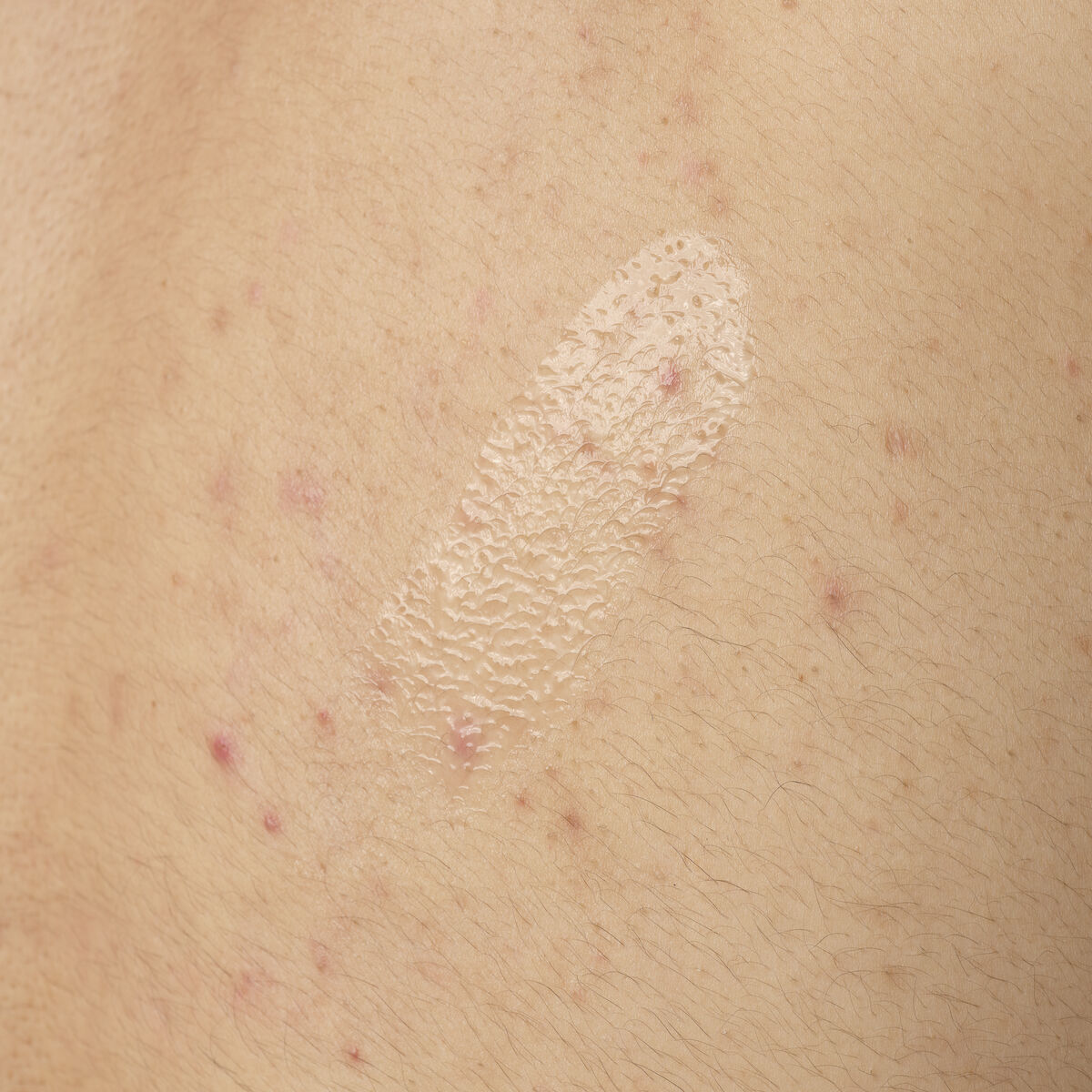 salicylic-acid-0-5-body-serum-r0 ORD-salicylic-acid-05-body-240ml-application.jpg