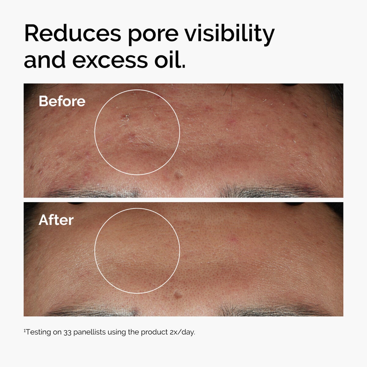 niacinamide-10-zinc-1-h8 ord-niacinamide-zinc-blemish-serum-before-after-pores.jpg