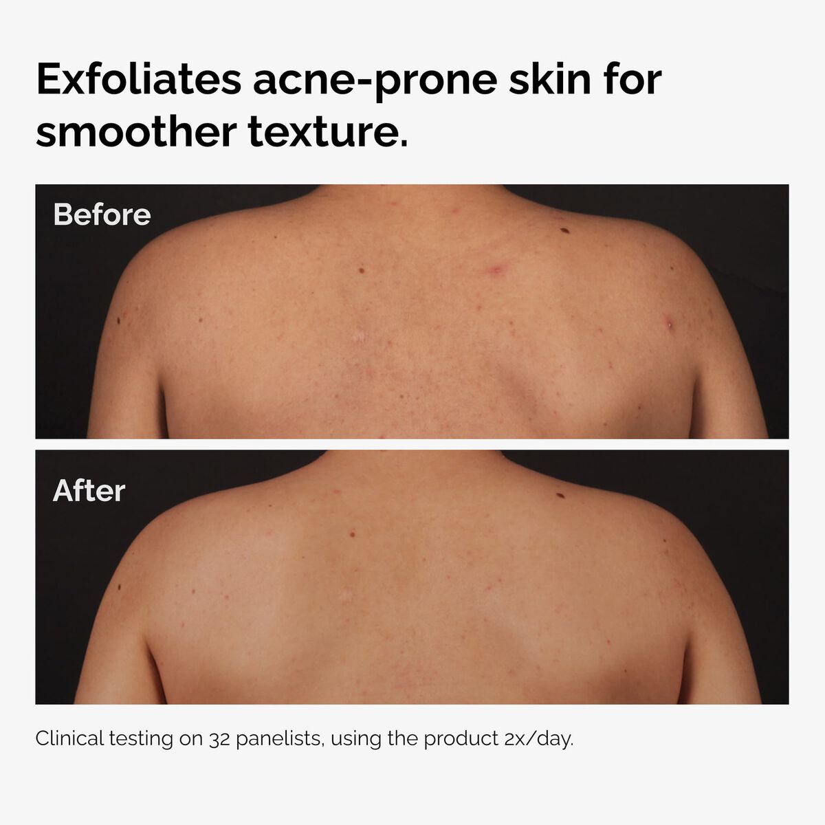 salicylic-acid-0-5-body-serum-r0 ord-salicylic-acid-body-serum-before-after-graphic-NA.jpg